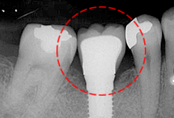 インプラント治療後X線写真